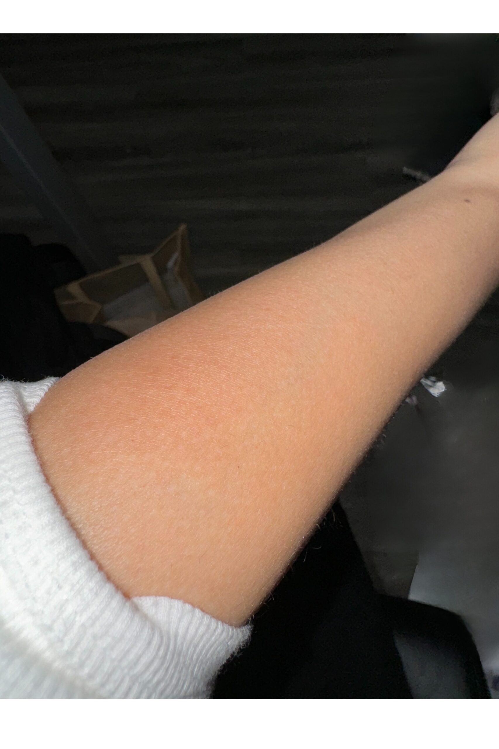 Arm hair regrowth present day 2024